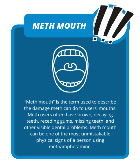 What Is Meth Mouth Carolina Center For Recovery